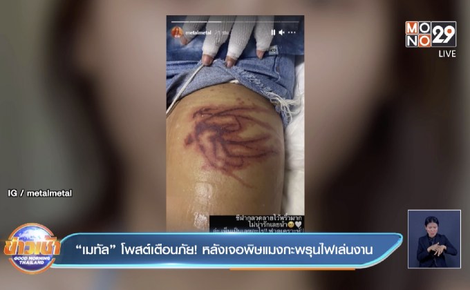 “เมทัล” โพสต์​เตือนภัย! หลังเจอพิษแมงกะพรุน​ไฟเล่นงาน