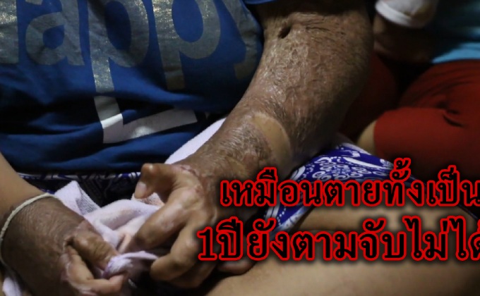 ครอบครัวร้องสื่อ แฉผัวโหด! ราดน้ำมันเผาอดีตเมียเสียโฉม หลังคดีไม่คืบหน้ากว่า 1 ปี ( คลิป )