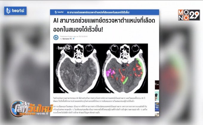 AI ช่วยแพทย์หาตำแหน่งที่เลือดออกในสมอง