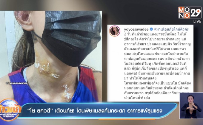 “โย ยศวดี” เตือนภัย! โดนพิษแมลงก้นกระดก อาการแพ้รุนแรง