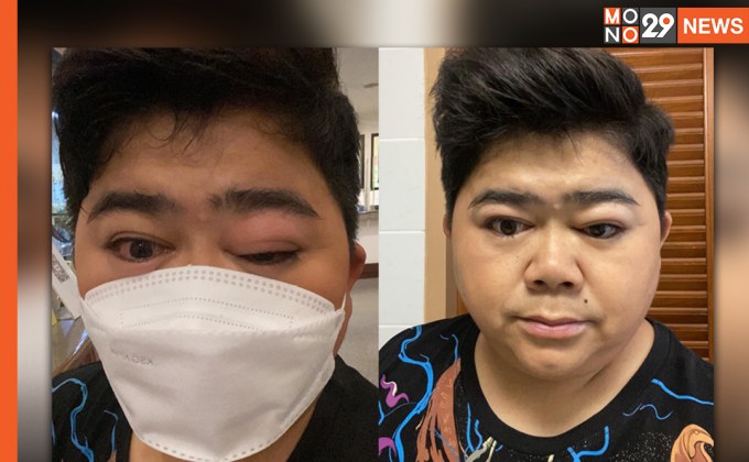 ตาบวมปูด! “โก๊ะตี๋ อารามบอย” แพ้อาหารขั้นรุนแรง หลังกินแมงป่องไป 3 ตัว