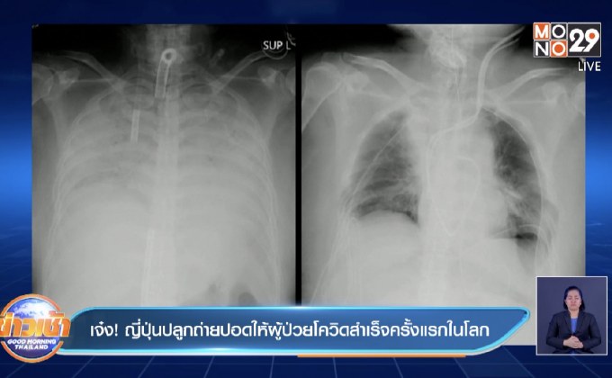 ญี่ปุ่น ประสบความสำเร็จ ปลูกถ่ายปอดให้ผู้ป่วยโควิด