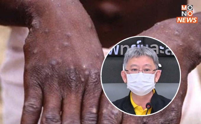 ผู้ป่วยยืนยันโรคฝีดาษวานร รายที่ 8 เป็นชาวไทย เดินทางกลับมาจากประเทศกาตาร์