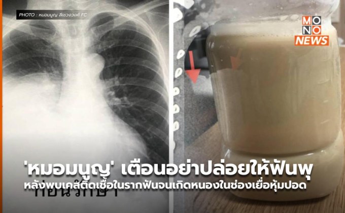 ‘หมอมนูญ’ เตือนอย่าปล่อยให้ฟันพุ หลังพบเคสติดเชื้อในรากฟันจนเกิดหนองในช่องเยื่อหุ้มปอด