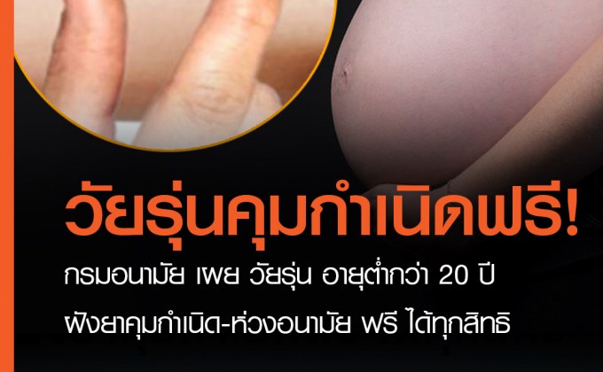 กรมอนามัย เผย วัยรุ่น อายุต่ำกว่า 20 ปี ฝังยาคุมกำเนิด-ห่วงอนามัย ฟรี ได้ทุกสิทธิ